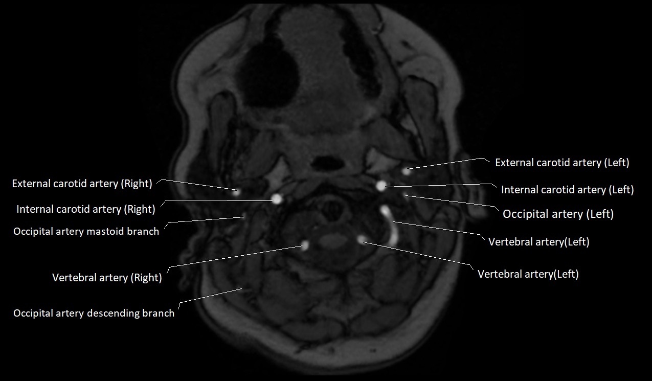 Carotid artery anatomy axial 3T image 10.jpg